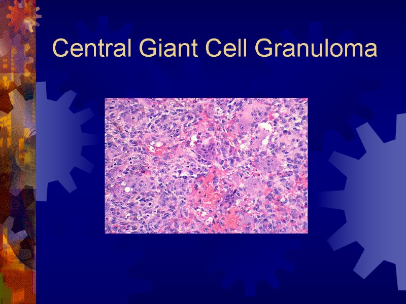 Central Giant Cell Granuloma